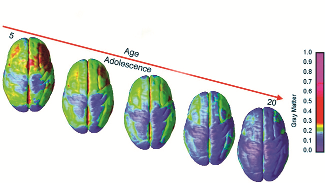 Image showing plan view of brain with heat map colours denoting changes in grey matter density from age 13 to age 18