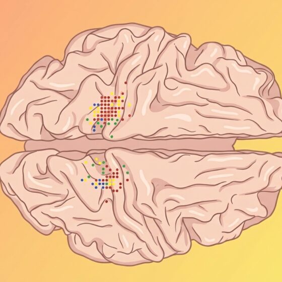 Illustration of a grid of coloured dots overlying outer brain cortex demonstrating extra thinning of regions responsible for producing genital sensations; altered as a consequence of historic sexual child abuse compared to control participants not abused as children